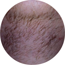 More permanent way of removing unwanted hair?