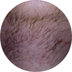 More permanent way of removing unwanted hair?