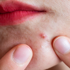 Dr Coleman discusses what causes acne, and what can you do about it?